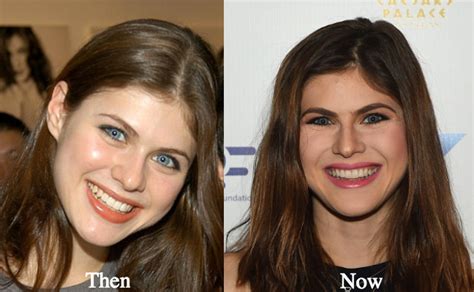 did alexandra daddario get a boob job|10 Stars Who Have Undergone Breast Reduction Surgery